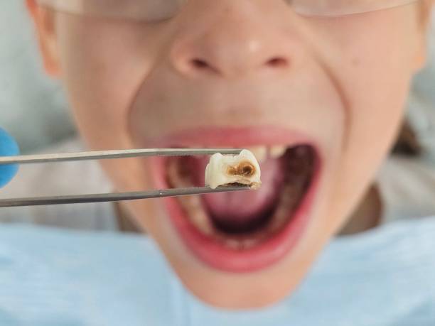 Best Cracked Tooth Emergency Dentist  in Spotsylnia Courthouse, VA