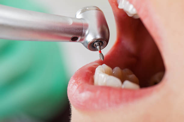 Teeth Whitening in VA